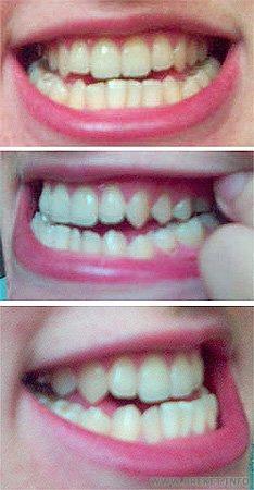 2.jpg Прикус после прорезывания восьмёрок