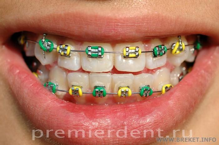 ortodont_2314057_full.jpg Разноцветные лигатурки на зубах
