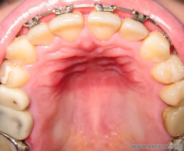 IMG_2762web.jpg След от аппарата на нёбе