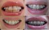 ulybka_sravn_1d_3m_6m_12m.jpg