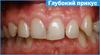 Глубокий прикус