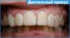 Дистальный прикус