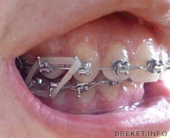 тяги ромбиком)