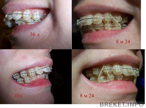 тяги для смыкания