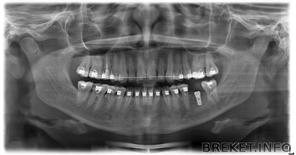 имплантация