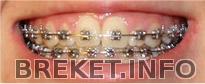 Брекеты