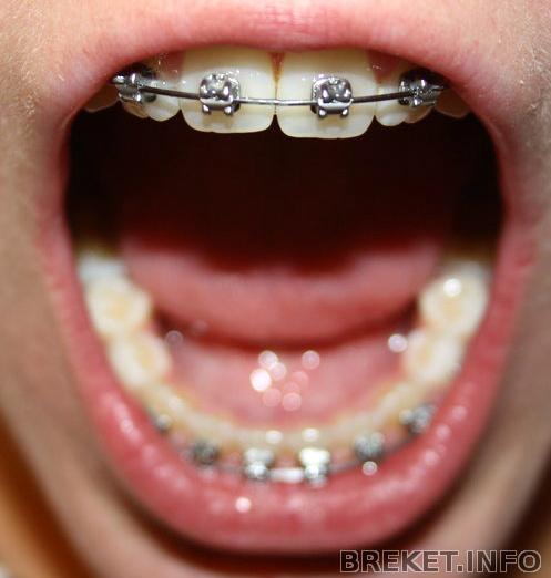 Брекеты