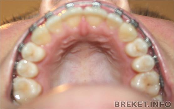 Брекеты