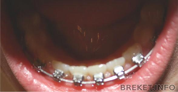 Брекеты
