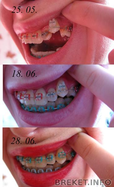 прогрессирует)