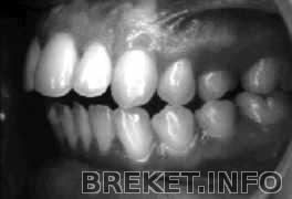 Открытый прикус