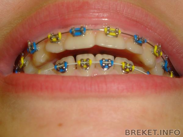 это мой прикус((