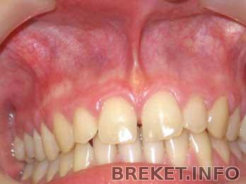 уздечка верхней губы