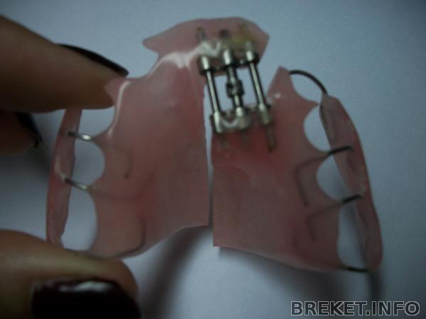 пластинка, двигающая зубной ряд слева назад.jpg