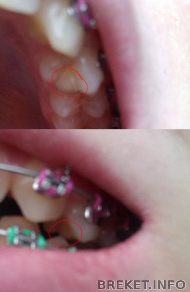 Зуб с наростом