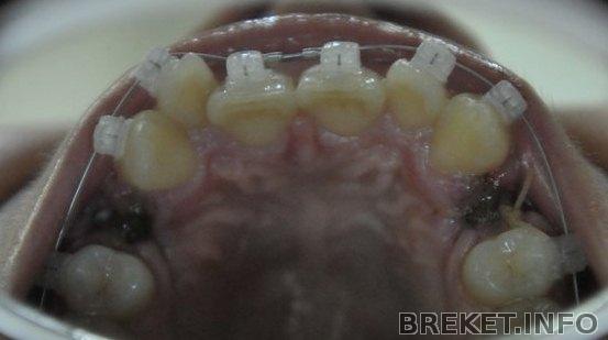 Дырки от удаления (ВЧ).jpg