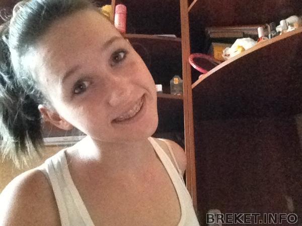 Вот она я) и брекеты мои)