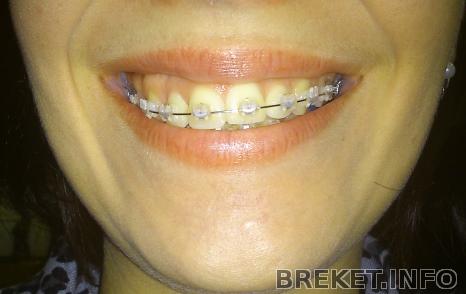 1 год 2 месяца - перекос