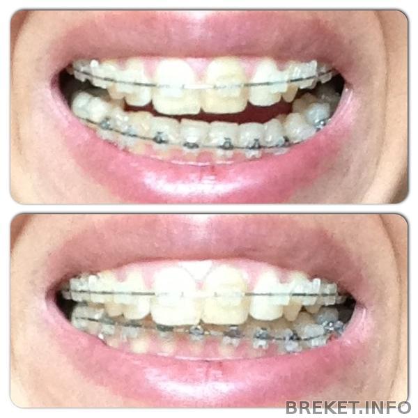 7 мес. и 15 дней. Упор на нижнюю челюсть