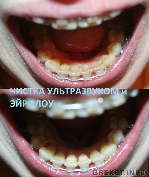 чистка
