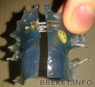 Пластинка с винтом для расширения челюсти