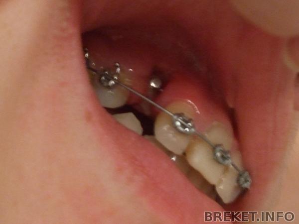 ретинированный зуб