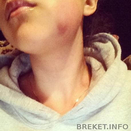 Отек после удаления нижней восьмерки