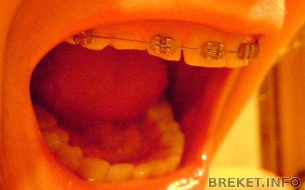 сразу можно заметить как молочный стерся ( до удаления)