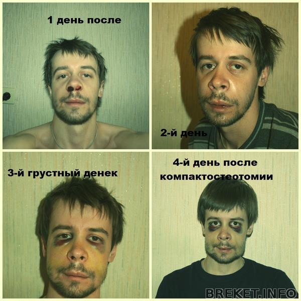 operacia_1-4_dni_g.jpg компактостеотомия