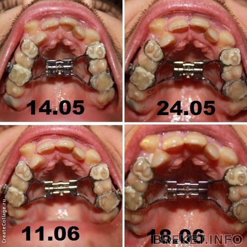 Расширение челюсти