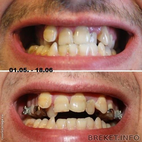 небный расширитель