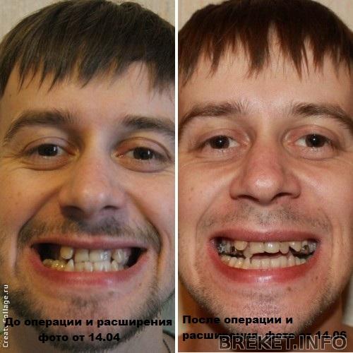 результат компактостеотомии