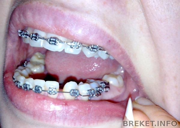 тянем 4 ( 6 дуга на НЧ)