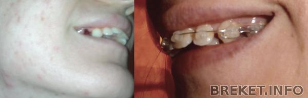 _спустя 3 месяца_ _спустя 3 месяца_