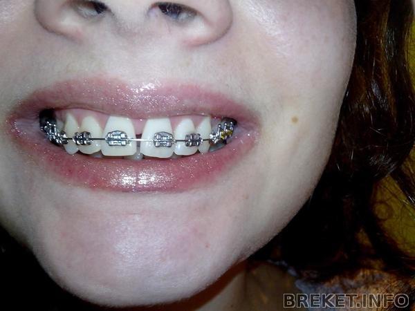 3 мес 20 дней.jpg 3 мес 20 дней. Так не любимые мной щели на единичках. Даже не улыбаюсь себе