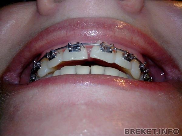 3 мес 20 дней.jpg Верхняя челюсть нависает над нижней челюстью. Появляется дырень. Между челюстями