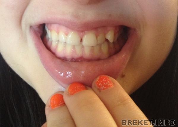 До установки