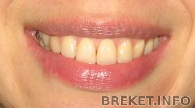 После После