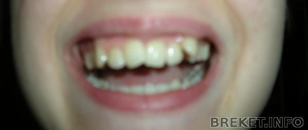 До удаления четверок