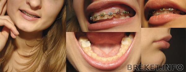 нижняя челюсть