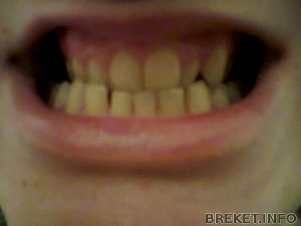 Сжатые зубы