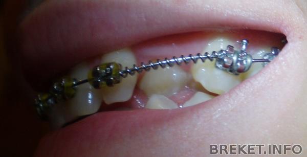 Бок верхнего клыка упирается в верхушку нижнего