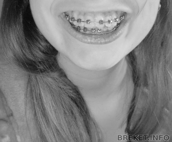 Неправильная форма некоторых верхних зубов