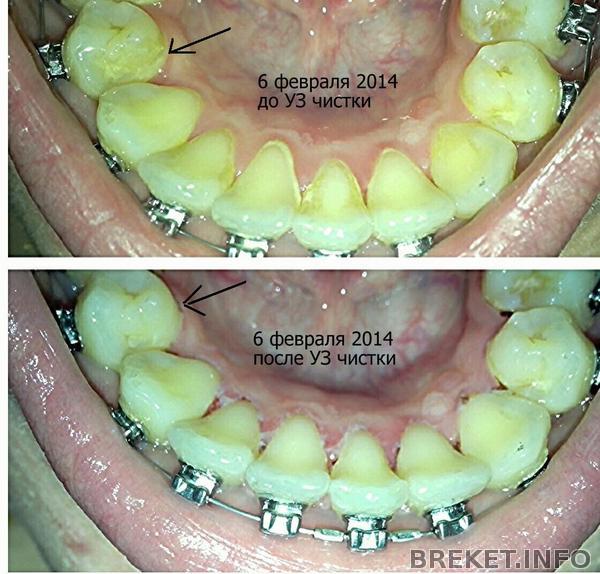 Чистка зубного камня