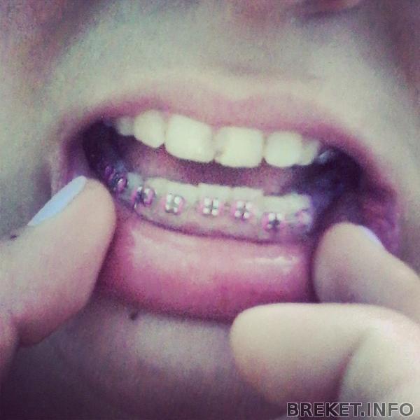 my pink braces