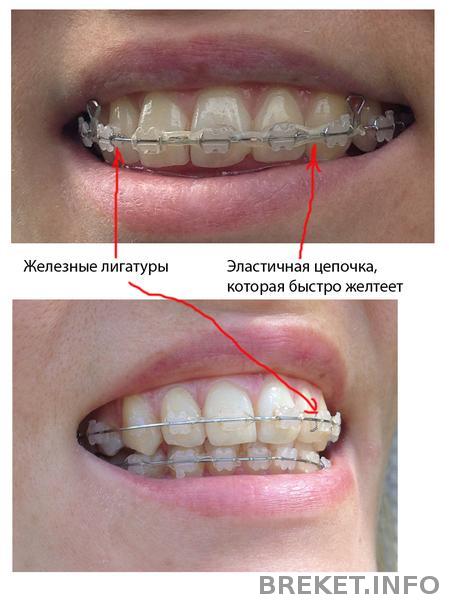 zheleznye_ligatury.jpg