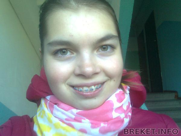 уже в брекетах